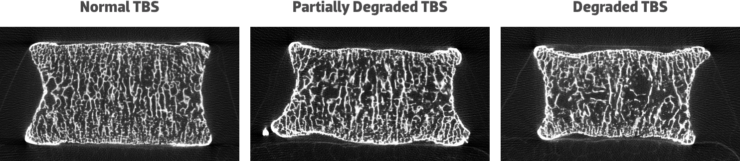 Example of three categories of trabecular bone score (TBS)