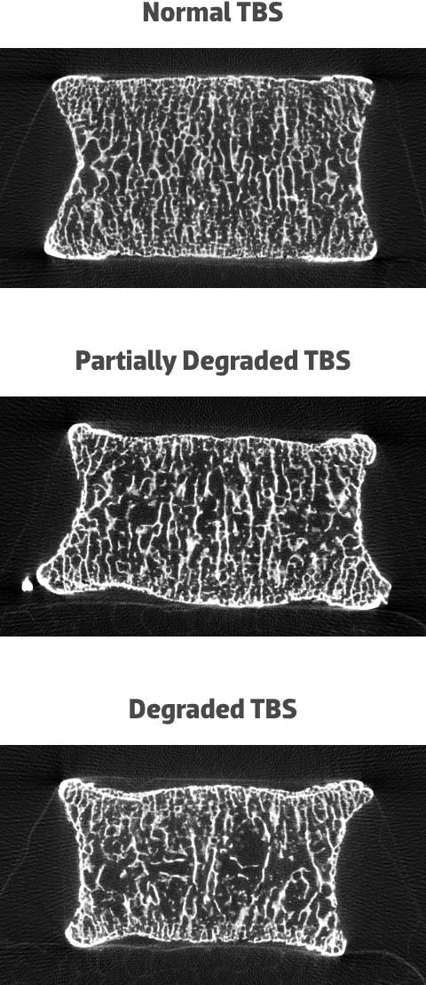 Tbs Reference Chart Study Design: Retrospective Analysis: TBS | Prolia® (denosumab) HCP